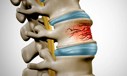 Spinal Fracture Treatment