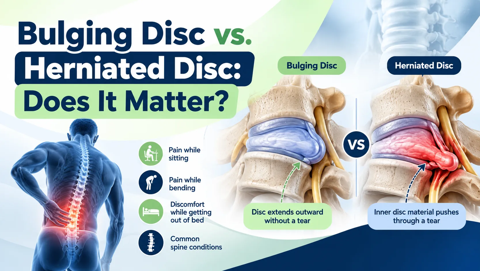 Bulging Disc vs. Herniated Disc: Does It Matter